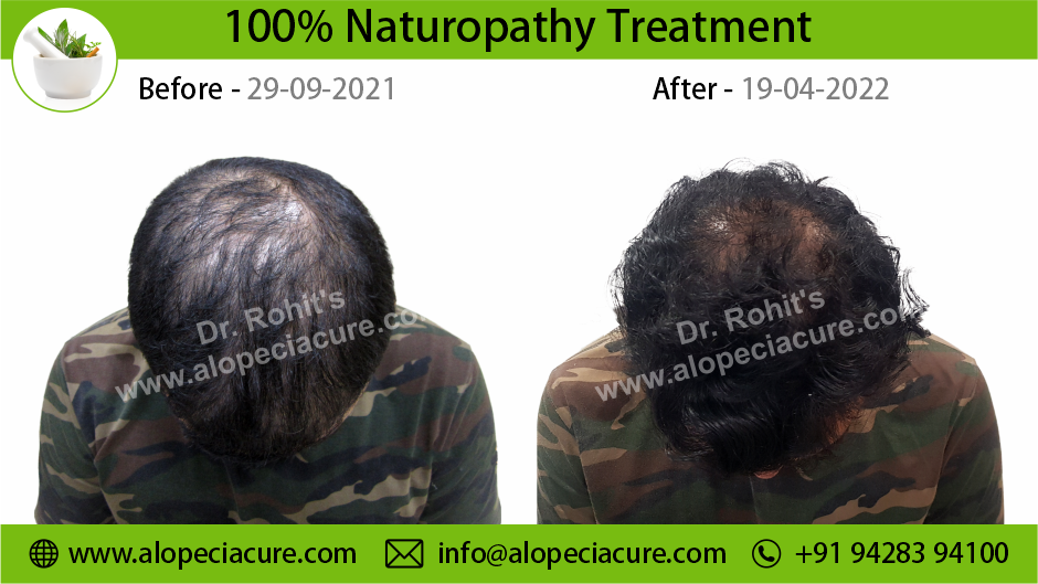 male hair loss treatment